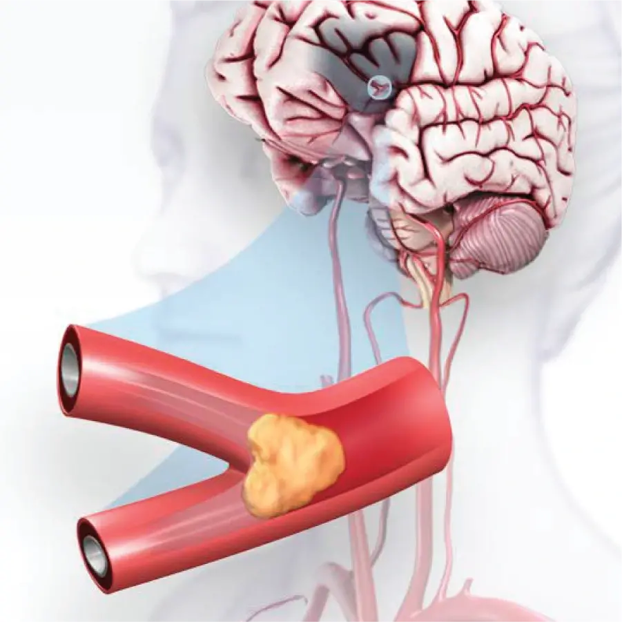 hospital for stroke treatment
